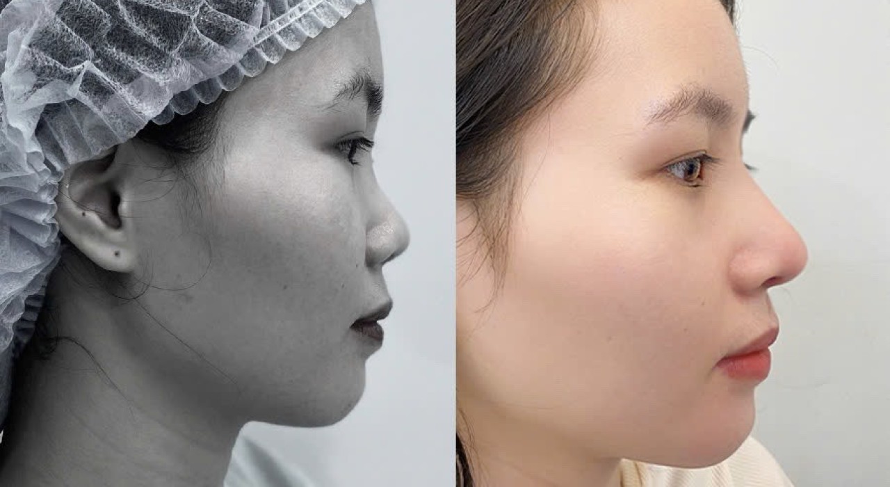 PHẪU THUẬT NÂNG MŨI BẰNG SỤN TỰ THÂN (sụn vành tai)
