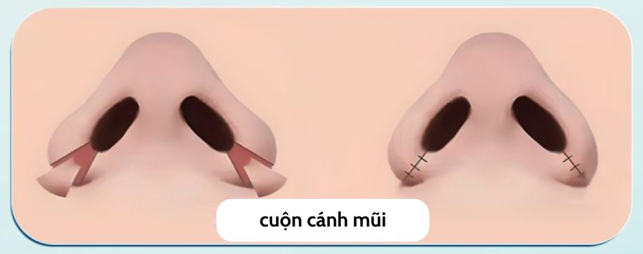 PHẪU THUẬT THU GỌN CÁNH MŨI