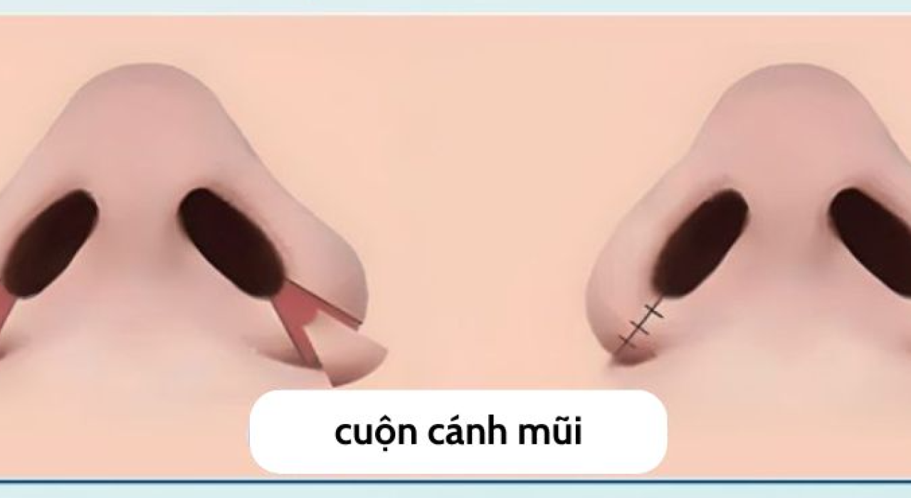PHẪU THUẬT THU GỌN CÁNH MŨI