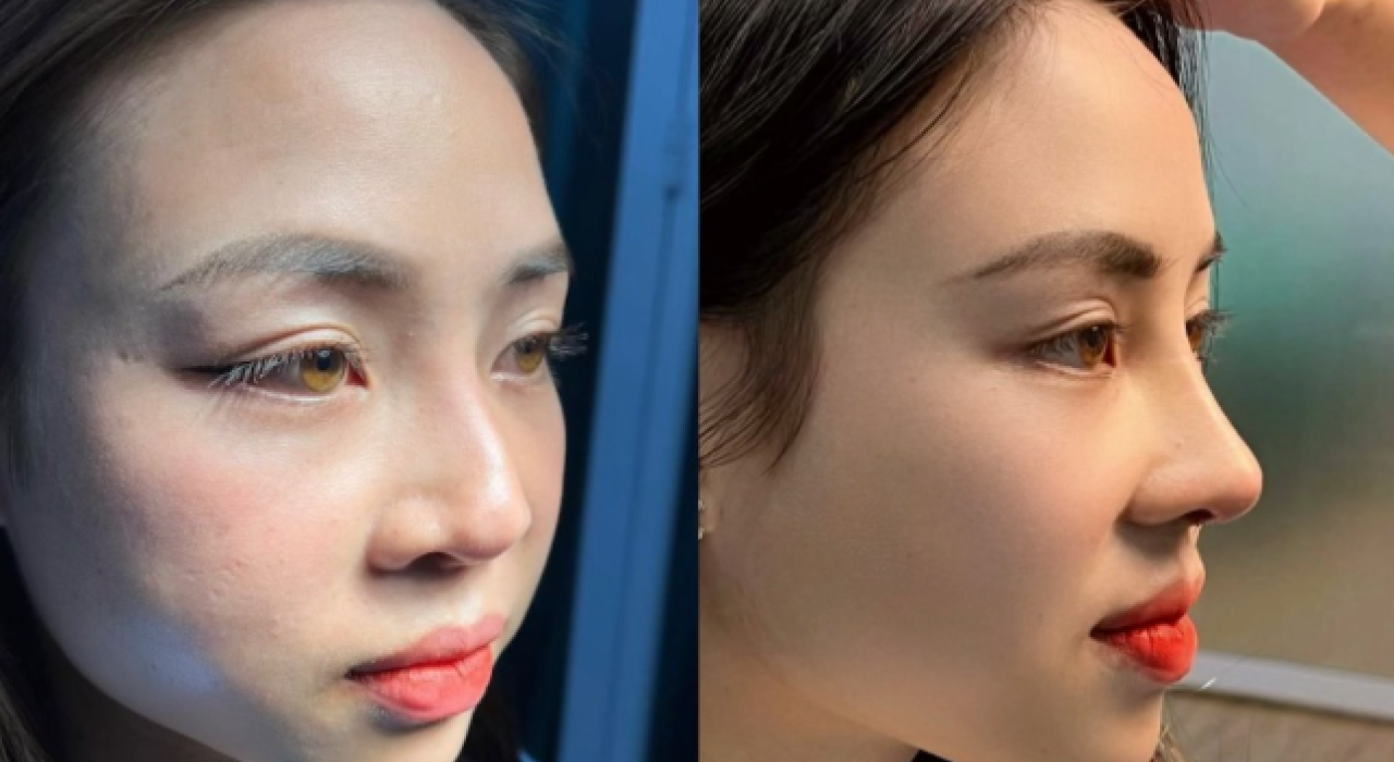 PHẪU THUẬT CHỈNH HÌNH MŨI GỒ (KỸ THUẬT MÀI XƯƠNG)