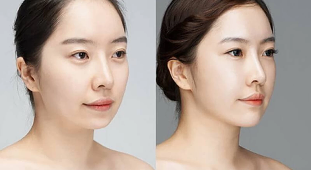 PHẪU THUẬT CHỈNH HÌNH CẰM BẰNG CẤY MỠ